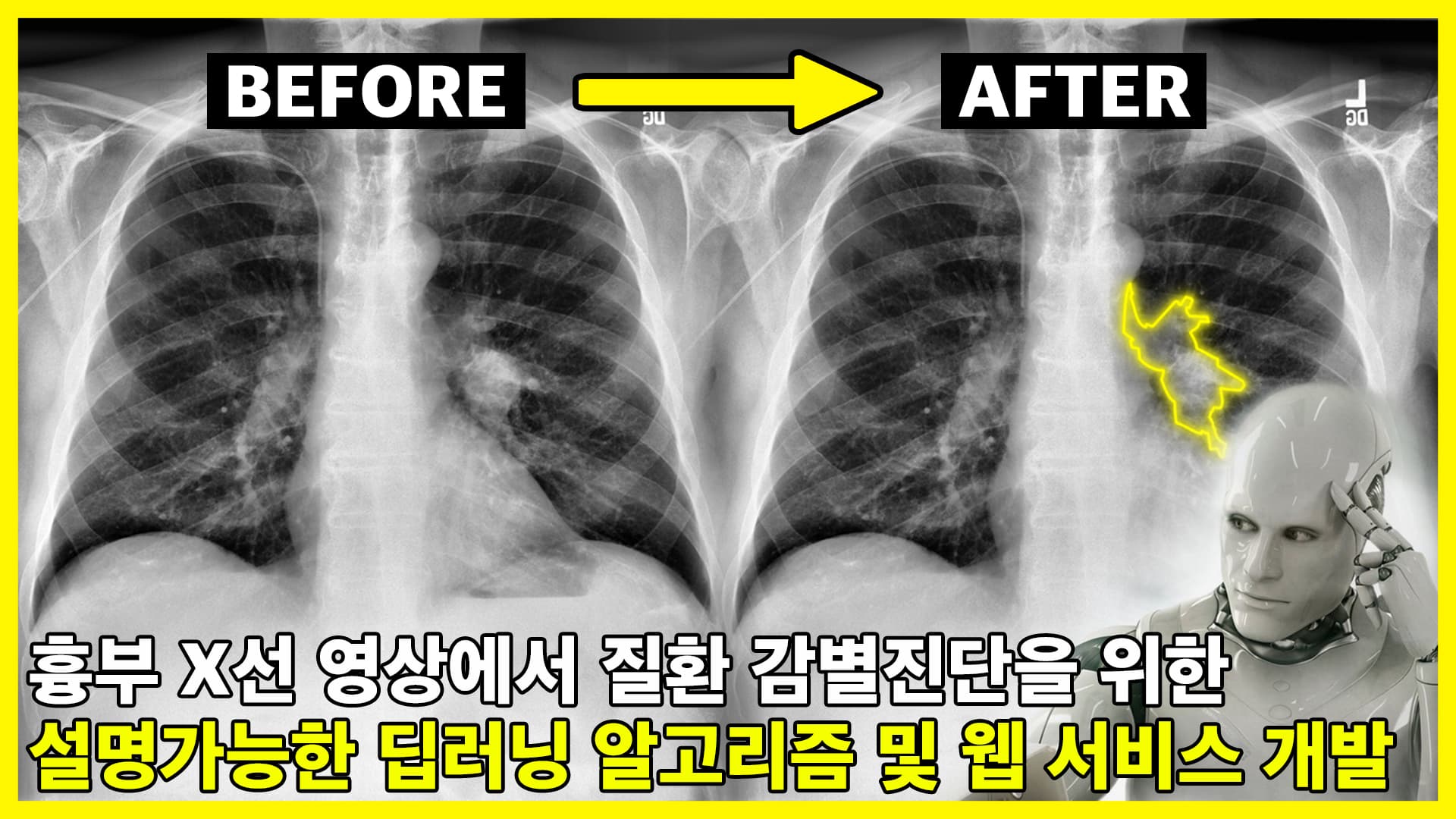 흉부 X선 영상에서 질환 감별진단을 위한 설명가능한 딥러닝 알고리즘 및 웹 서비스 개발